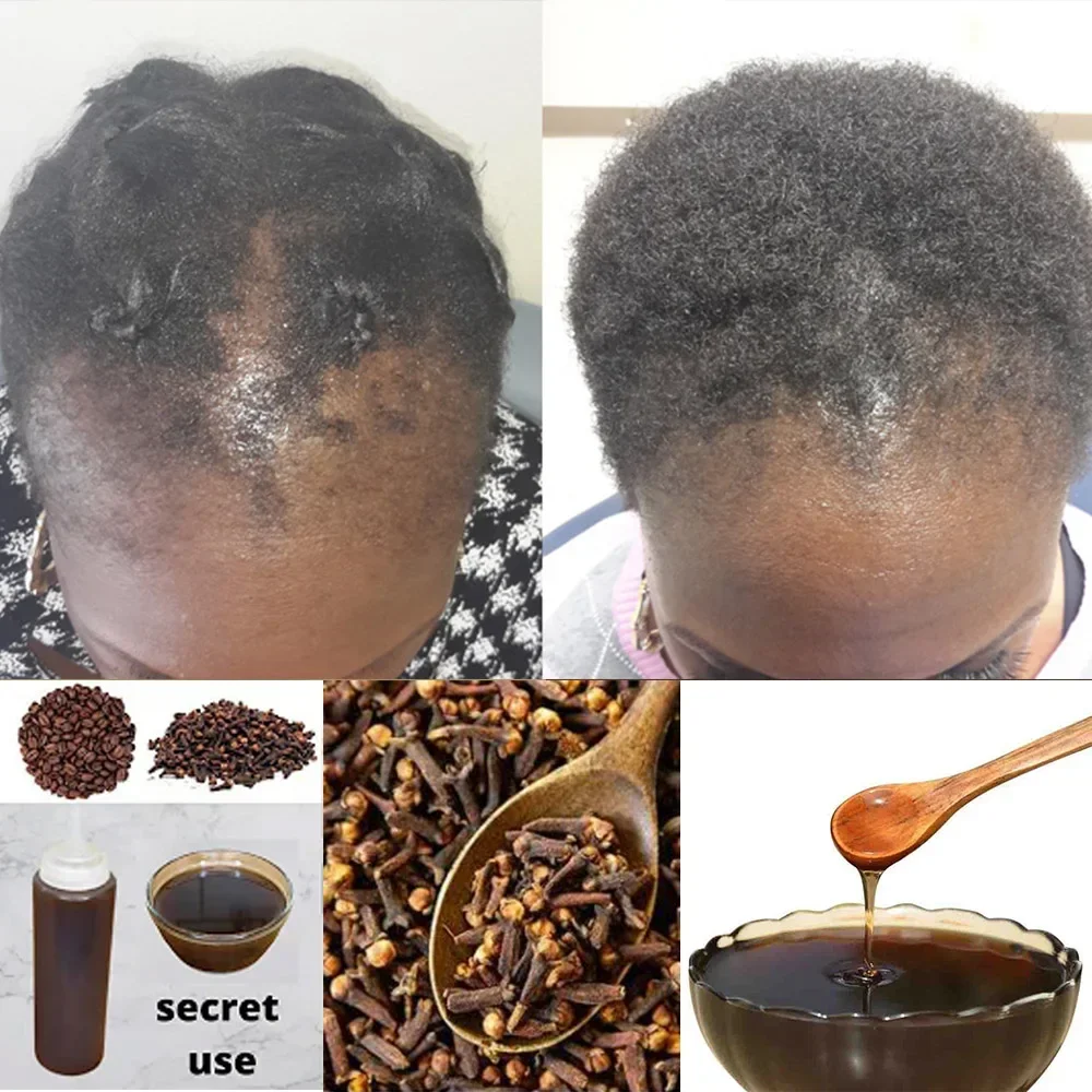 Africa Women Traction Alopecia - đánh giá và giá Hair Care Ginseng