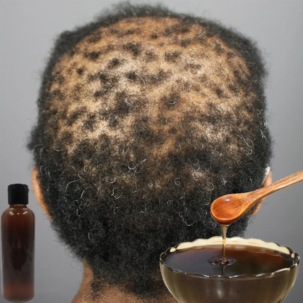 Africa Women Traction Alopecia - đánh giá và giá Hair Care Ginseng