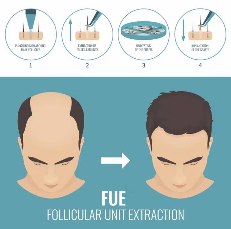 FUE Hair Implant Micro Motor H - đánh giá và giá Hair Care With Protein